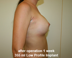 plastic-surgery-breast-augmentation